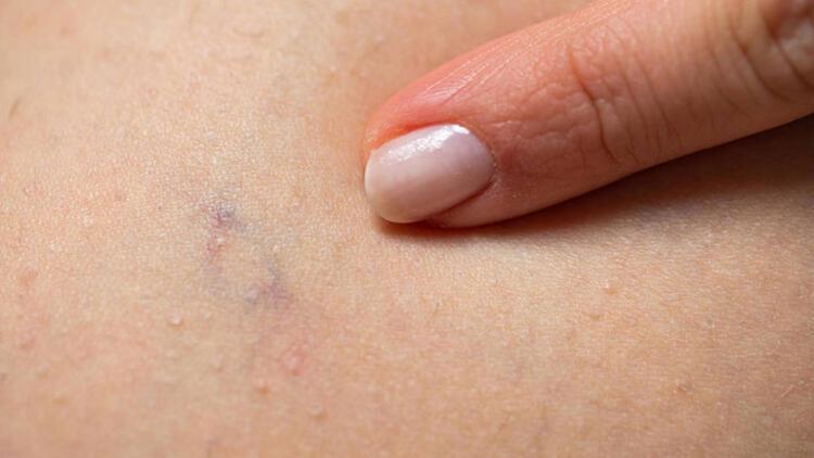 Varis Nedir? Belirtileri, Nedenleri ve Önleme Yöntemleri
