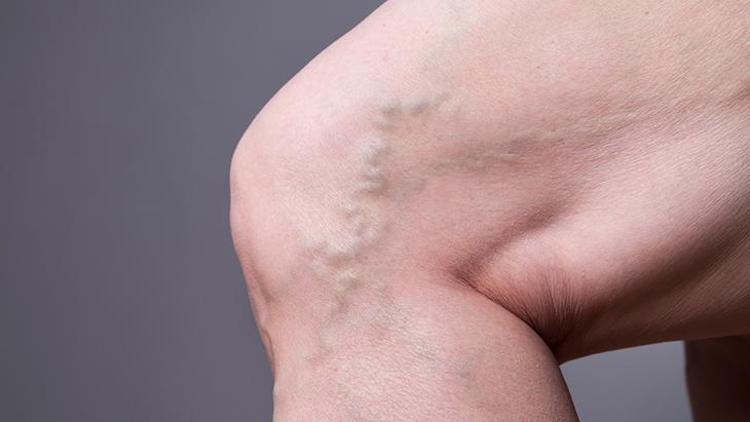 Varis Nedir? Belirtileri, Nedenleri ve Önleme Yöntemleri