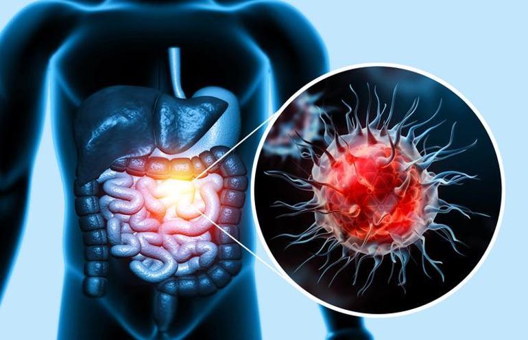 36 Yaşındaki Zoe'nin Bağırsağında Tespit Edilen Kanser Tümörü ve Erken Teşhis Önemi