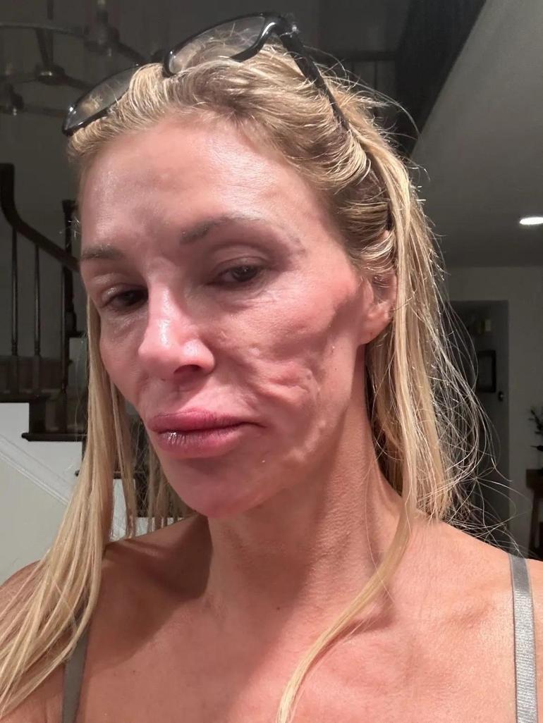 Brandi Glanville'ın Sağlık Mücadelesi: Yüzündeki Parazitler ve Tedavi Süreci
