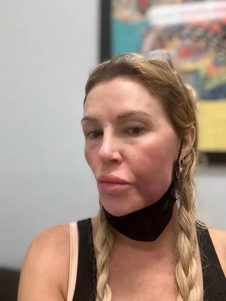 Brandi Glanville'ın Sağlık Mücadelesi: Yüzündeki Parazitler ve Tedavi Süreci